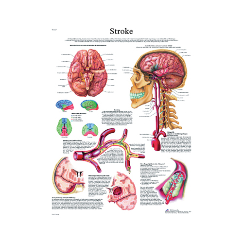 FNT12-4629P - Fabrication Enterprises - Anatomical Chart - Stroke Chart Paper