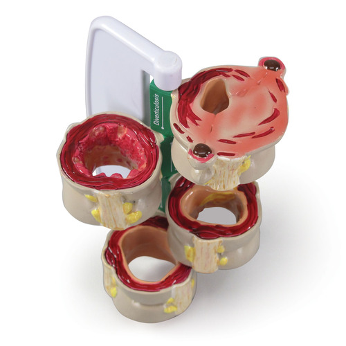 GPI3341 - GPI Manufacturing - 4-Piece Colon (with Pathologies)