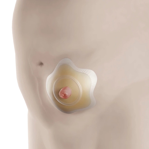 MON1124396BX - Coloplast - Ostomy Barrier SenSura Mio Convex Flip Trim To Fit, Standard Wear Red Code 3/8 to 1-3/4 Inch Stoma, 5 EA/BX