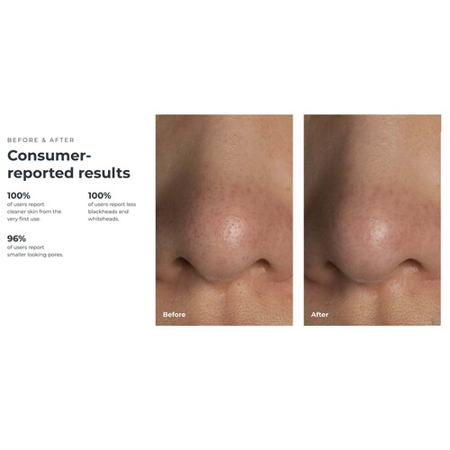 MON1259139EA - Foreo - Foreo Blackhead Remover Pore Vacuum KIWI