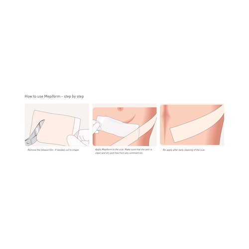 MON712218BX - Molnlycke Healthcare - Molnlycke Healthcare Mepiform Silicone Scar Dressing 4X7in