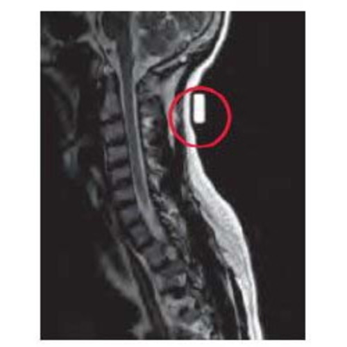 MON888152BX - PDC Healthcare - PDC Healthcare Radiology Skin Marker MRI Spee-D-Mark