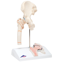 FNT12-4577 - Fabrication Enterprises - Anatomical Model - Femoral Fracture and Hip Osteoarthritis