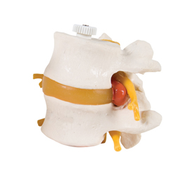 FNT12-4595 - Fabrication Enterprises - Anatomical Model - 2 Lumbar Vertebrae with Prolapsed Disc, Flexibly Mounted