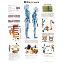 FNT12-4615P - Fabrication Enterprises - Anatomical Chart - Osteoporosis, Paper