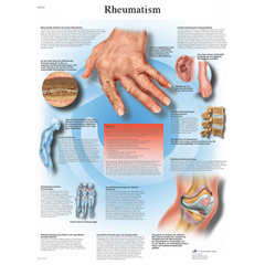 FNT12-4618L - Fabrication Enterprises - Anatomical Chart - Rheumatic Diseases, Laminated