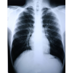 McKesson X-Ray Film Clear Choice Performance 8 X 10 Inch High Speed Blue Sensitive High, 500 per Case