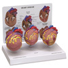 GPI Manufacturing 3-Mini Heart Set GPI2550