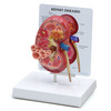 GPI Manufacturing Kidney (Normal/Pathologies) GPI3260